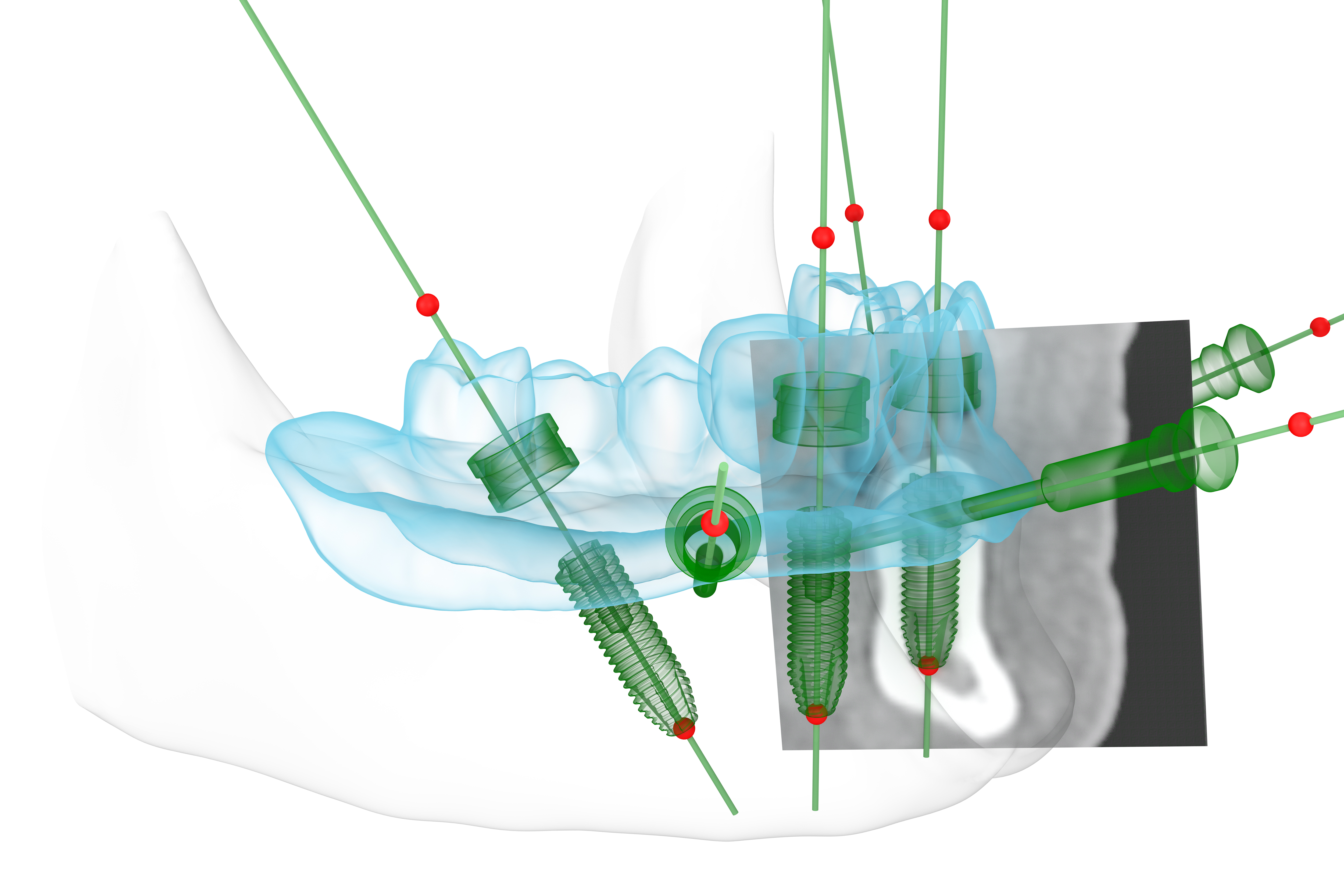 Die Behandlung digital planen anhand eines DVT Die Behandlung digital planen anhand eines DVT
