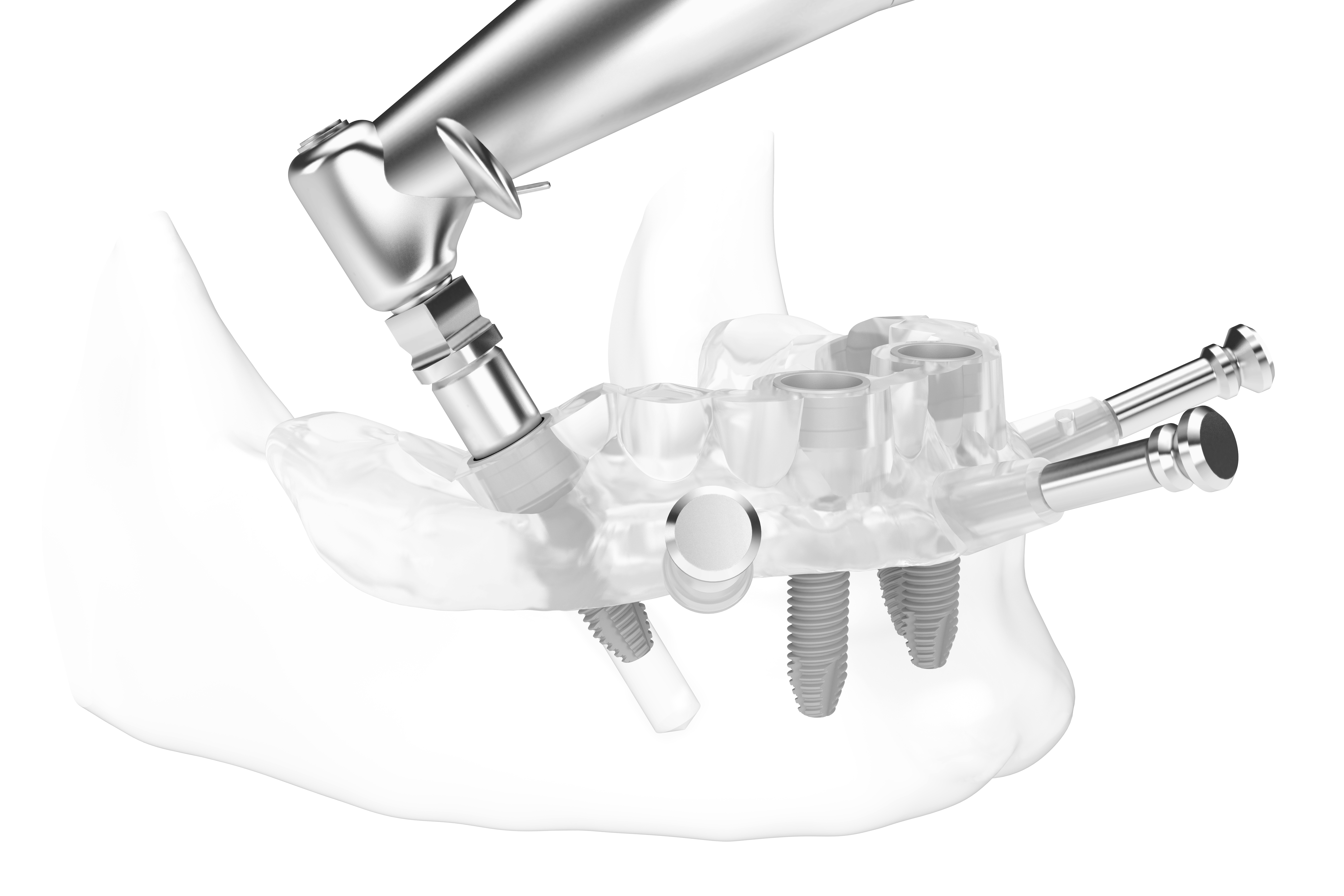 Geführtes einbringen der Implantate mittels einer Bohrschablone Geführtes einbringen der Implantate mittels einer Bohrschablone
